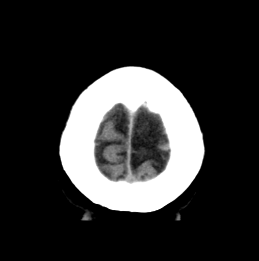 File:Cerebral cavernous venous malformations (Radiopaedia 48117-52945 Axial non-contrast 30).png