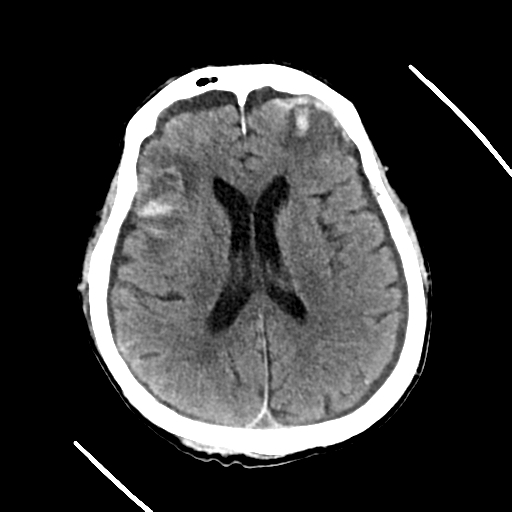 File:Cerebral contusions, subarachnoid hemorrhage and subdural hygromas (Radiopaedia 55399-61829 Axial non-contrast 15).png