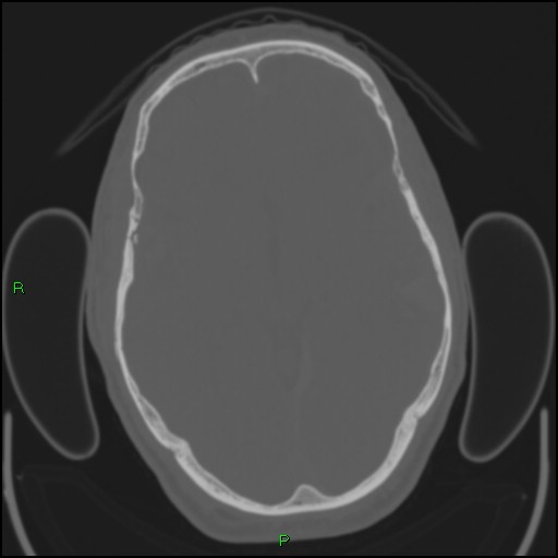 Cerebral contusions (Radiopaedia 33868-35039 Axial bone window 93).jpg