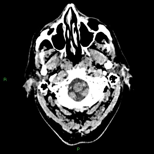Cerebral contusions (Radiopaedia 33868-35039 Axial non-contrast 14).jpg
