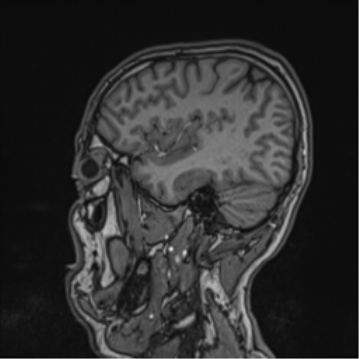 Cerebral fat embolism (Radiopaedia 57697-64639 Sagittal T1 37).png