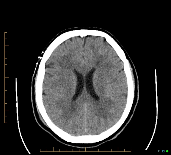 Cerebral fat embolism (Radiopaedia 85521-101220 Axial non-contrast 39).jpg
