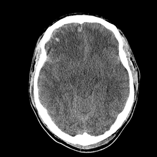 File:Cerebral hemorrhagic contusions- temporal evolution (Radiopaedia 40224-42753 Axial non-contrast 14).png