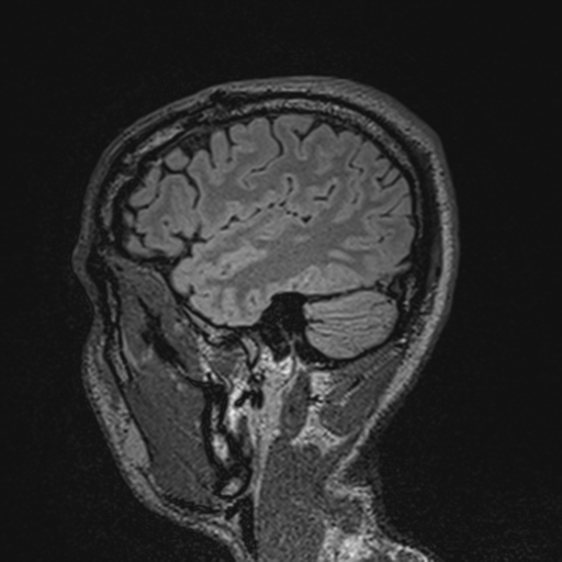 File:Cerebral hemorrhagic contusions- temporal evolution (Radiopaedia 40224-42757 Sagittal T1 17).png