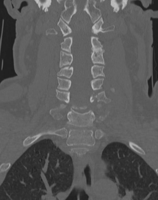 Cerebral hemorrhagic contusions and cervical spine fractures (Radiopaedia 32865-33841 Coronal bone window 33).jpg