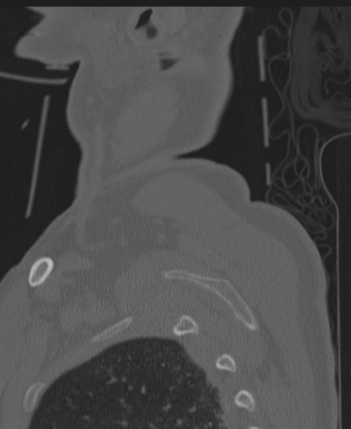 Cerebral hemorrhagic contusions and cervical spine fractures (Radiopaedia 32865-33841 Sagittal bone window 100).jpg