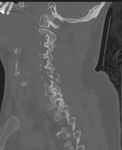 Cerebral hemorrhagic contusions and cervical spine fractures (Radiopaedia 32865-33841 Sagittal bone window 41).jpg