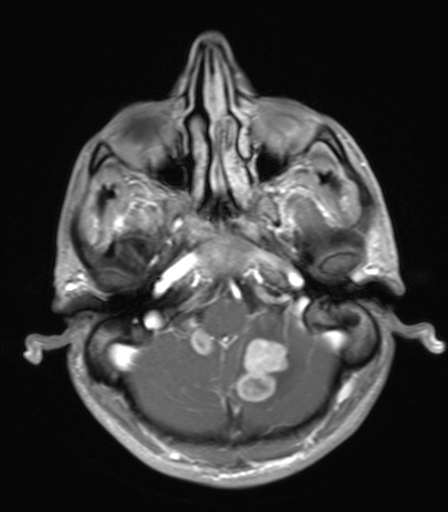 File:Cerebral metastases (Radiopaedia 29781-30303 B 1).jpg