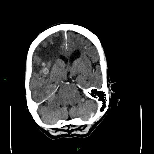 Cerebral metastases - breast primary (Radiopaedia 77653-89857 Axial C+ delayed 44).jpg