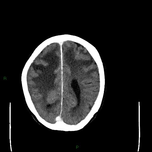 Cerebral metastases - breast primary (Radiopaedia 77653-89857 Axial C+ delayed 81).jpg