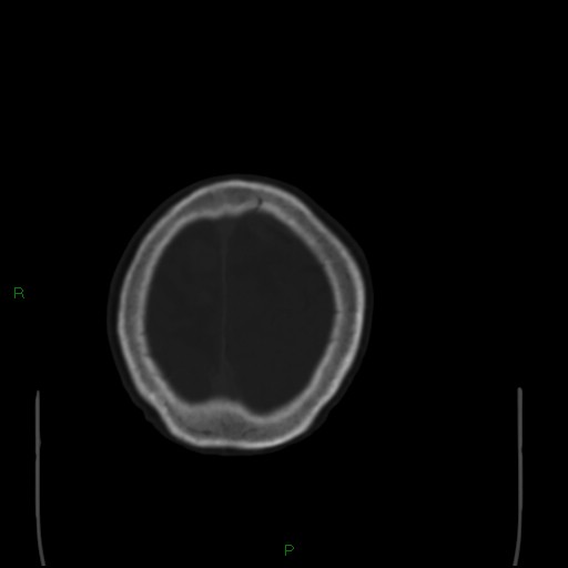 Cerebral metastases - breast primary (Radiopaedia 77653-89857 Axial bone window 104).jpg