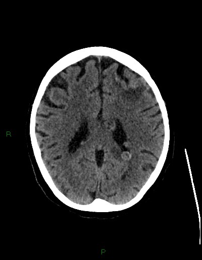 Cerebral metastases - ependymal and parenchymal (Radiopaedia 79877-93131 Axial non-contrast 50).jpg
