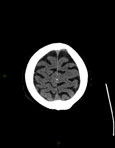 File:Cerebral metastases - ependymal and parenchymal (Radiopaedia 79877-93131 Axial non-contrast 71).jpg