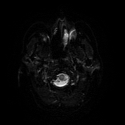 Cerebral metastases - melanoma (Radiopaedia 80972-94522 Axial DWI 67).jpg