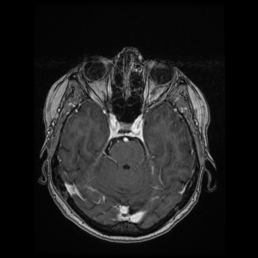 Cerebral metastases - melanoma (Radiopaedia 80972-94522 Axial T1 C+ 42).jpg