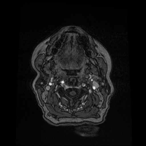 Cerebral metastases - melanoma (Radiopaedia 80972-94522 Axial T1 C+ 8).jpg
