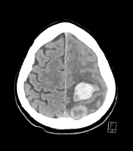 Cerebral metastases - testicular choriocarcinoma (Radiopaedia 84486-99855 Axial non-contrast 14).jpg
