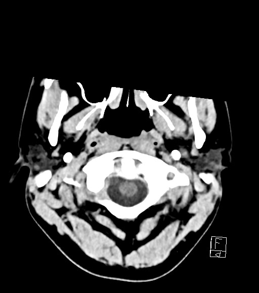 Cerebral metastases - testicular choriocarcinoma (Radiopaedia 84486-99855 Axial non-contrast 52).jpg