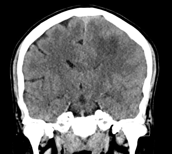 Cerebral metastases - testicular choriocarcinoma (Radiopaedia 84486-99855 Coronal C+ delayed 33).jpg