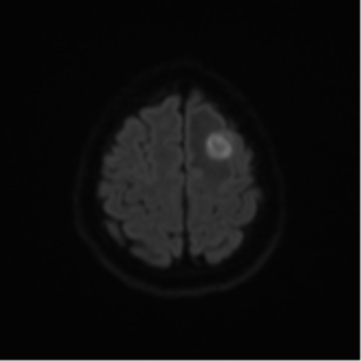Cerebral metastases mimicking abscesses (Radiopaedia 45841-50131 Axial DWI 52).png