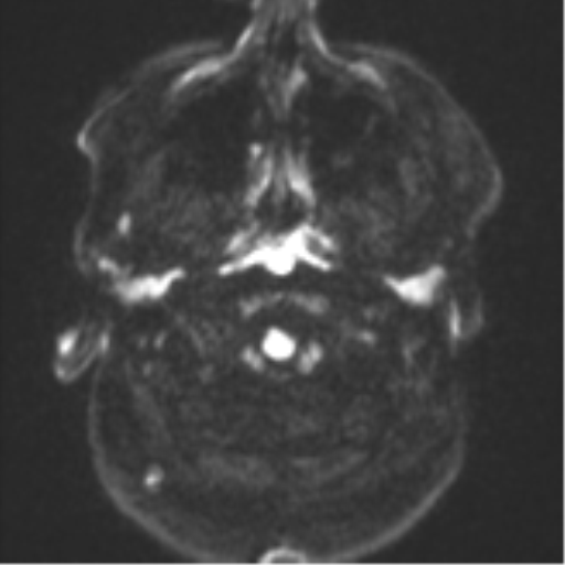File:Cerebral metastases mimicking multifocal glioblastoma (Radiopaedia 50843-56353 Axial DWI 30).png