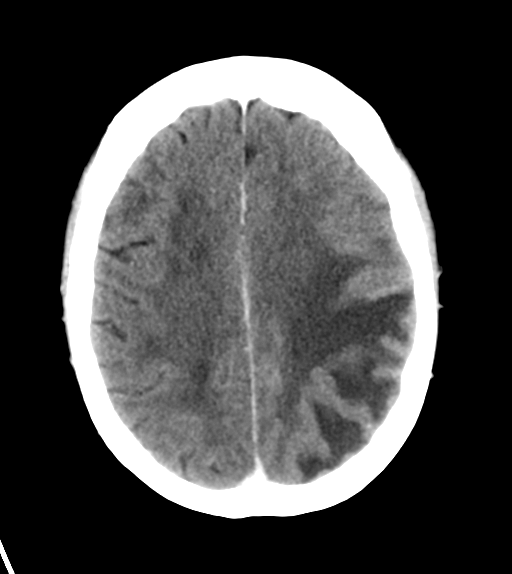 File:Cerebral metastasis (Radiopaedia 46744-51260 Axial C+ delayed 21).png