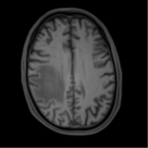 Cerebral metastasis - melanoma (Radiopaedia 54718-60954 Axial T1 36).png