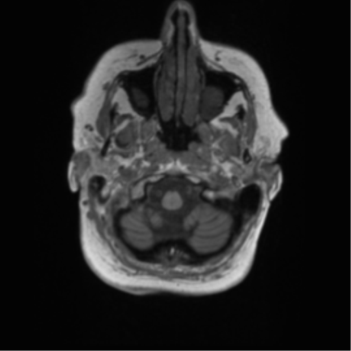 Cerebral metastasis mimicking glioblastoma (Radiopaedia 69155-78937 Axial T1 1).png