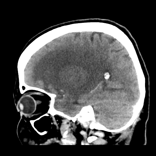 Cerebral metastasis to basal ganglia (Radiopaedia 81568-95412 Sagittal C+ delayed 20).png