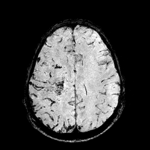 Cerebral parenchymal arteriovenous malformation (Radiopaedia 27280-27456 Axial SWI 85).jpg