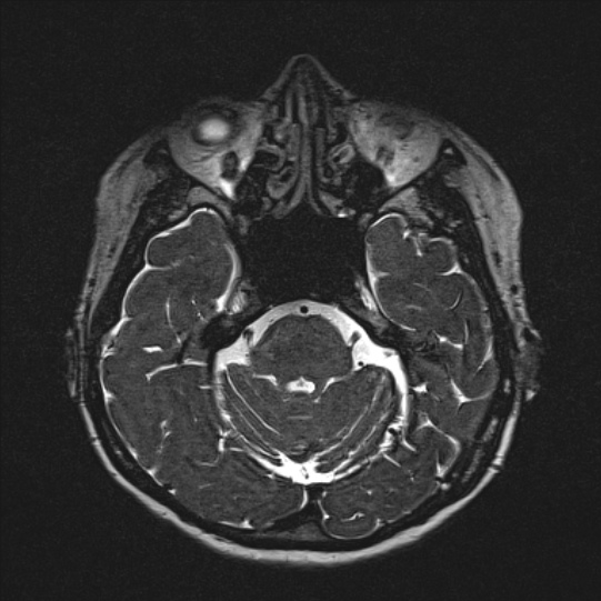 Cerebral ring enhancing lesions - cerebral metastases (Radiopaedia 44922-48817 F 48).jpg