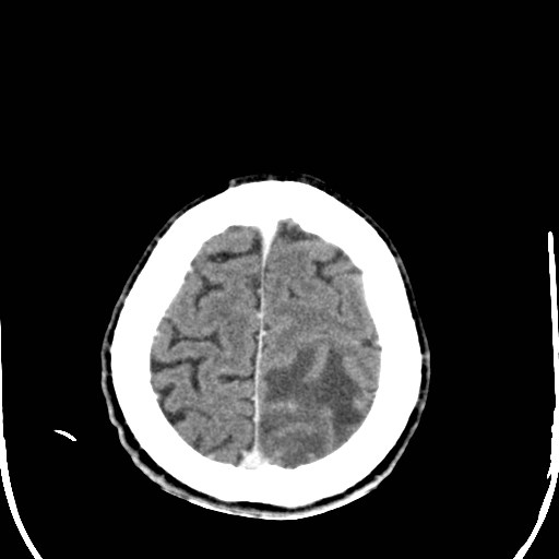 File:Cerebral toxoplasmosis (Radiopaedia 43956-47460 Axial C+ delayed 38).jpg