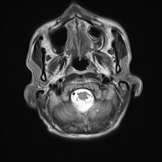 File:Cerebral toxoplasmosis (Radiopaedia 43956-47461 Axial T2 1).jpg