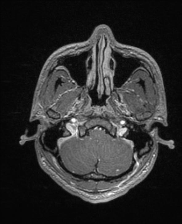 Cerebral toxoplasmosis (Radiopaedia 85779-101597 Axial T1 C+ 26).jpg