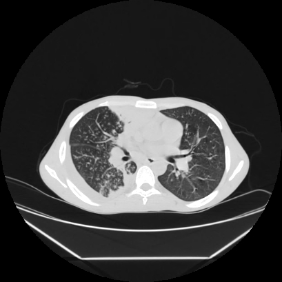 Cerebral tuberculoma (Radiopaedia 80829-94318 Axial lung window 82).jpg