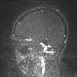 Cerebral tuberculosis with dural sinus invasion (Radiopaedia 60353-68090 Sagittal MRV 107).jpg