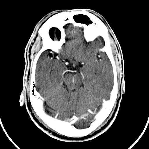 File:Cerebral venous angioma (Radiopaedia 69959-79977 B 25).jpg