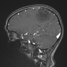 Cerebral venous infarction - hemorrhagic (Radiopaedia 81625-95505 Sagittal MRV 31).jpg