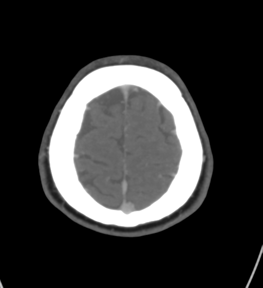 File:Cerebral venous infarction due to transverse sinus thrombosis (Radiopaedia 34688-36120 Axial CT venogram 44).png