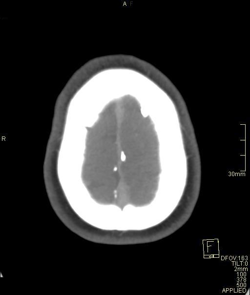 Cerebral venous sinus thrombosis (Radiopaedia 91329-108965 Axial venogram 72).jpg
