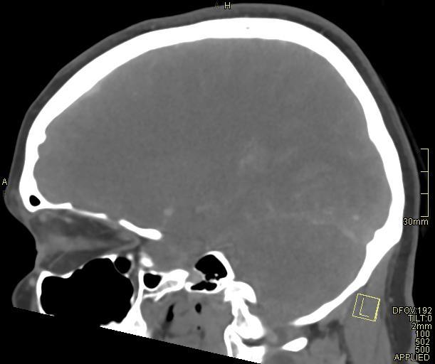 Cerebral venous sinus thrombosis (Radiopaedia 91329-108965 Sagittal venogram 48).jpg