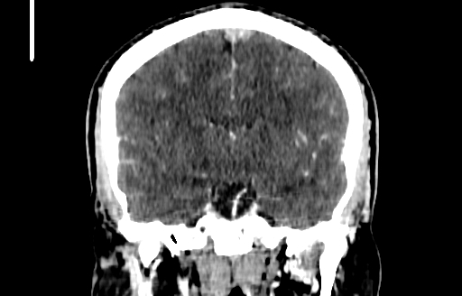 Cerebral venous thrombosis (CVT) (Radiopaedia 77524-89685 C 32).jpg