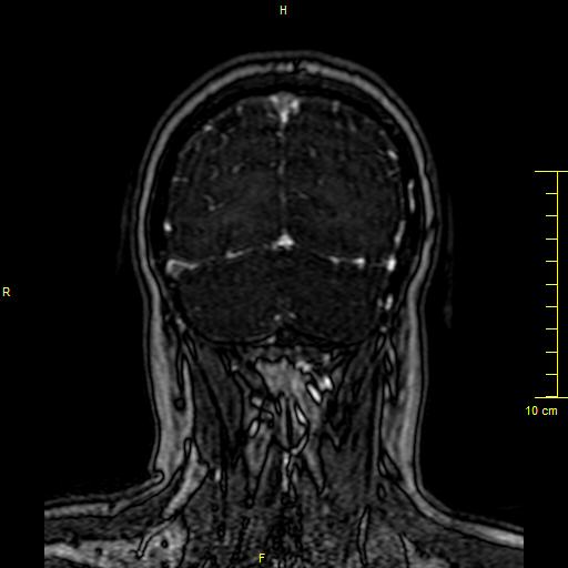 Cerebral venous thrombosis (Radiopaedia 23288-23351 MRV 146).JPG
