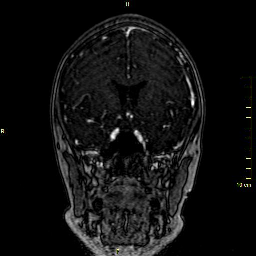 Cerebral venous thrombosis (Radiopaedia 23288-23351 MRV 45).JPG
