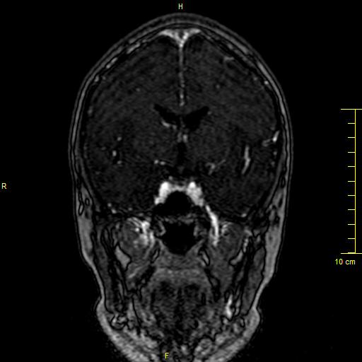 Cerebral venous thrombosis (Radiopaedia 23288-23351 MRV 59).JPG