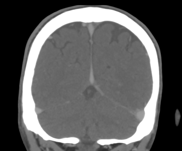 Cerebral venous thrombosis (Radiopaedia 38392-40467 Coronal CTA-Venogram 49).png