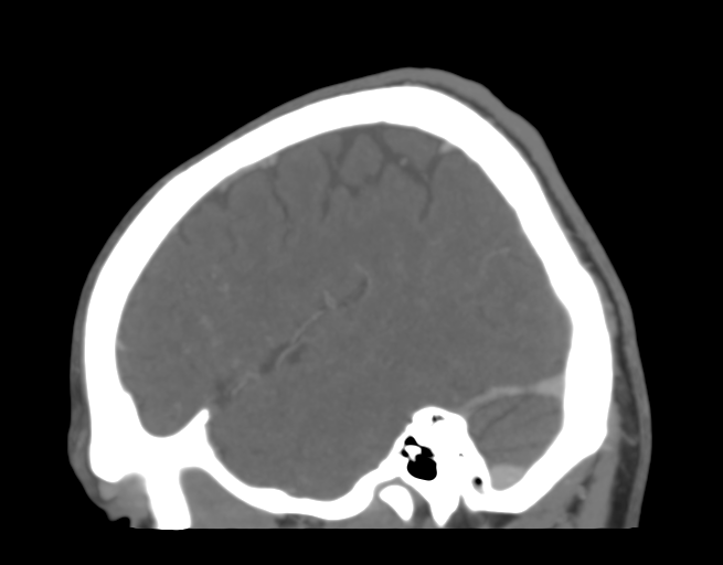 Cerebral venous thrombosis (Radiopaedia 38392-40467 D 42).png