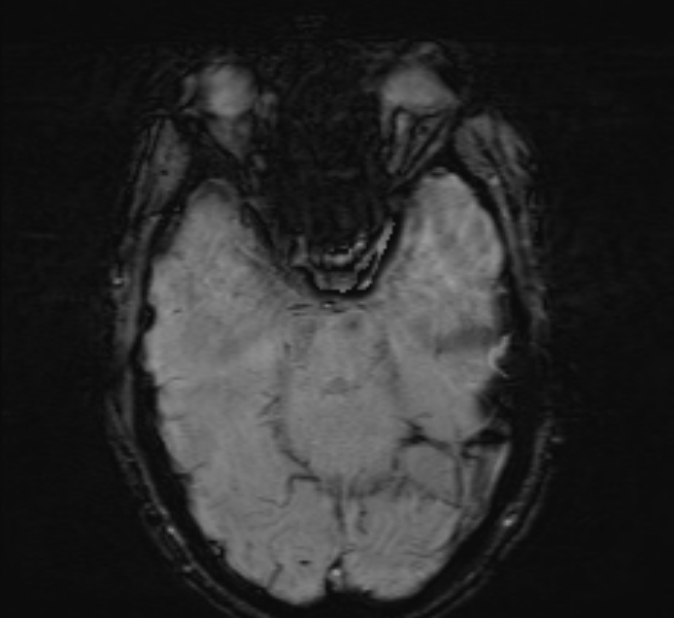 Cerebral venous thrombosis (Radiopaedia 71207-81504 Axial SWI 17).jpg