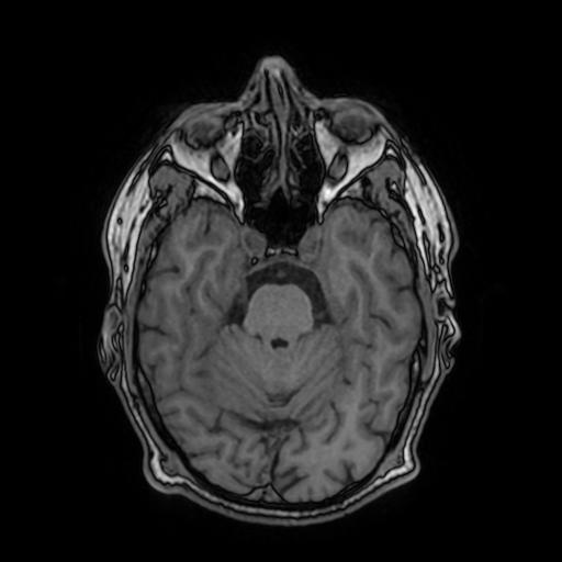 File:Cerebral venous thrombosis with secondary intracranial hypertension (Radiopaedia 89842-106957 Axial T1 67).jpg