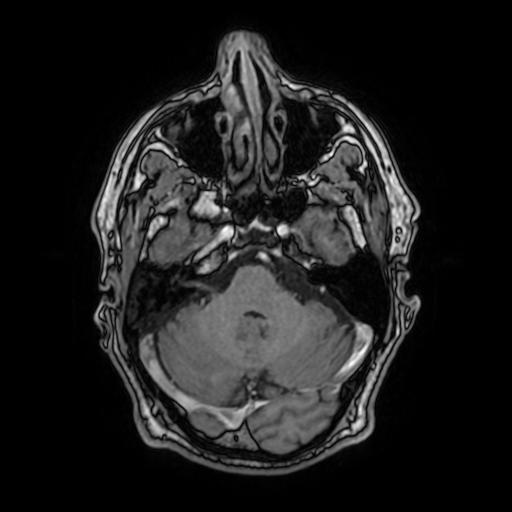 File:Cerebral venous thrombosis with secondary intracranial hypertension (Radiopaedia 89842-106957 Axial T1 C+ 58).jpg